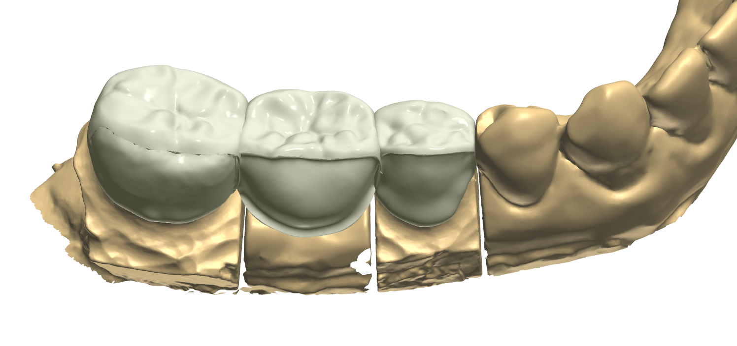 RĂNG SỨ VENEER